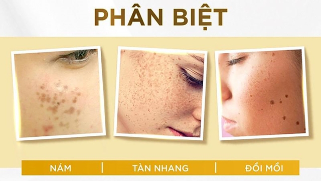 Tăng sắc tố da và 3 serum trị nám hiệu quả tại nhà không cần xâm lấn- Ảnh 2.