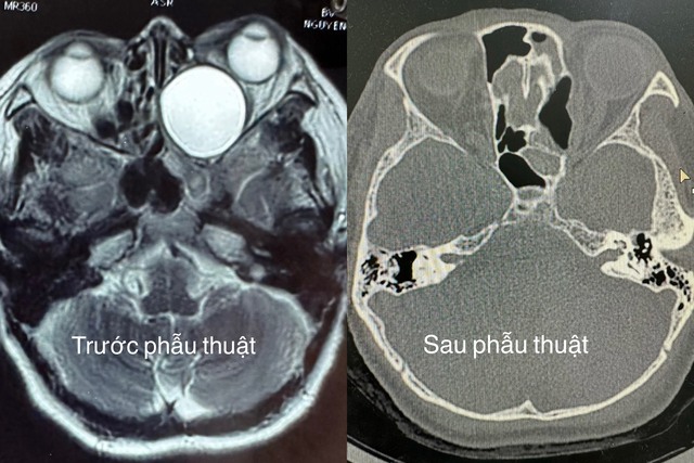Mất thị lực gần như hoàn toàn vì u nhầy 'khổng lồ' hiếm gặp- Ảnh 1.