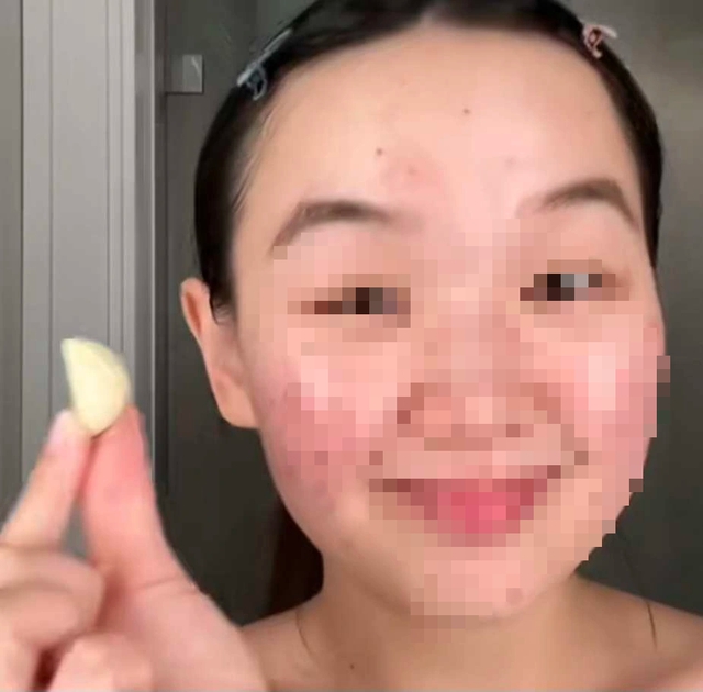 Có nên bắt chước trào lưu trị mụn bằng tỏi trên TikTok?- Ảnh 3. Có nên bắt chước trào lưu trị mụn bằng tỏi trên TikTok?- Ảnh 3.