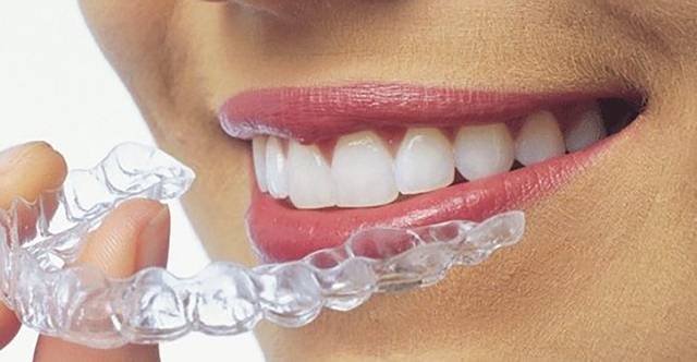 Niềng răng Invisalign: Hành trình ‘lột xác’ nụ cười cùng Nha khoa quốc tế Phú Hòa- Ảnh 1.