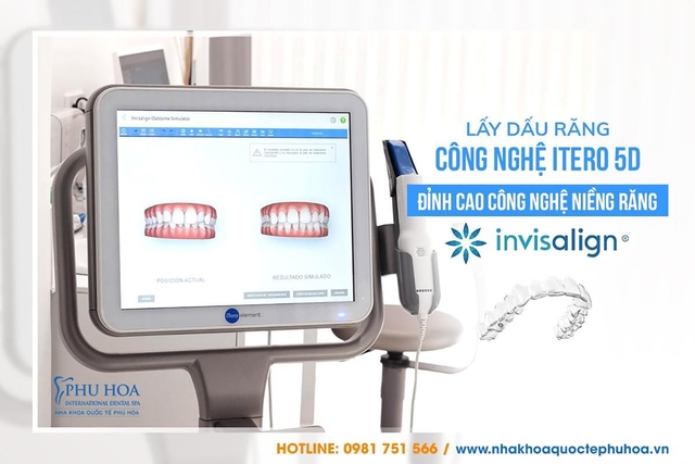 Niềng răng Invisalign: Hành trình ‘lột xác’ nụ cười cùng Nha khoa quốc tế Phú Hòa- Ảnh 3.