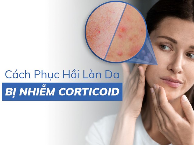 Làm thế nào để phục hồi làn da nhiễm corticoid khỏe đẹp trở lại?- Ảnh 1.