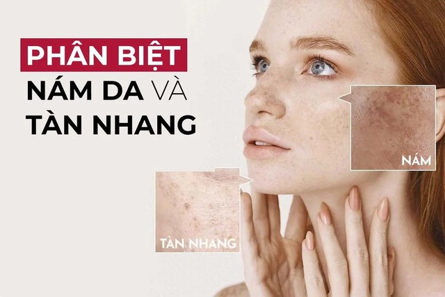 Đừng nhầm lẫn nữa! 5 dấu hiệu phân biệt nám và tàn nhang- Ảnh 1.