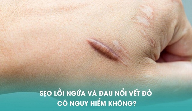 Sẹo lồi ngứa nguyên nhân do đâu? Cách điều trị sẹo lồi hiệu quả ngay tại nhà- Ảnh 2.