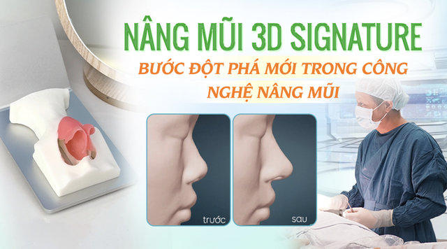 Nâng mũi 3D Signature, bước đột phá mới trong công nghệ nâng mũi- Ảnh 1.