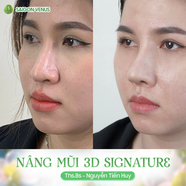 Nâng mũi 3D Signature, bước đột phá mới trong công nghệ nâng mũi- Ảnh 3.