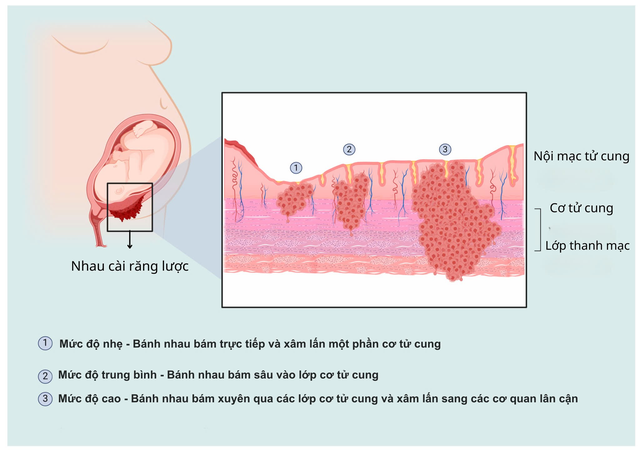 Bác sĩ FV kịch tính cứu sống sản phụ Thổ Nhĩ Kỳ bị băng huyết sau sinh- Ảnh 2.