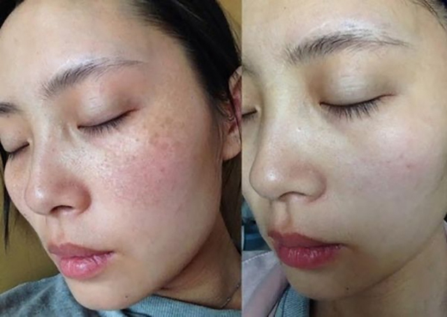 Top 10 kem dưỡng da trị nám, tàn nhang hiệu quả trong 4 tuần- Ảnh 1.