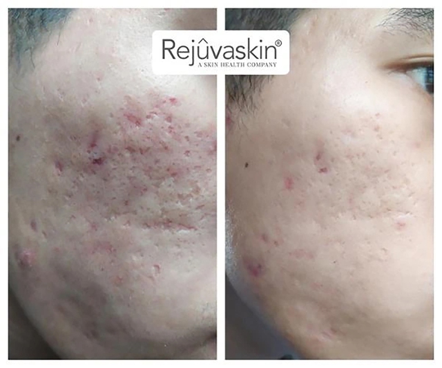 Review Rejuvaskin Scar Esthetique có hiệu quả trị sẹo rỗ, sẹo lõm, sẹo thâm trong 4 tuần?- Ảnh 4.