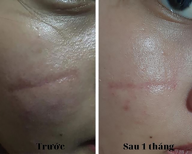 Review Rejuvaskin Scar Esthetique có hiệu quả trị sẹo rỗ, sẹo lõm, sẹo thâm trong 4 tuần?- Ảnh 6.