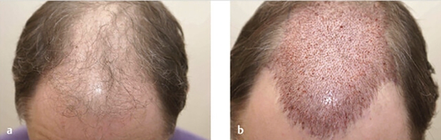 PGS.TS.BS Phạm Hiếu Liêm chia sẻ kỹ thuật cấy tóc FUT Hair Transplant- Ảnh 4.