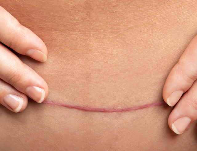 Sẹo kh&ocirc;ng chỉ ảnh hưởng thẩm mỹ m&agrave; c&ograve;n sức khỏe tinh thần- Ảnh 2.