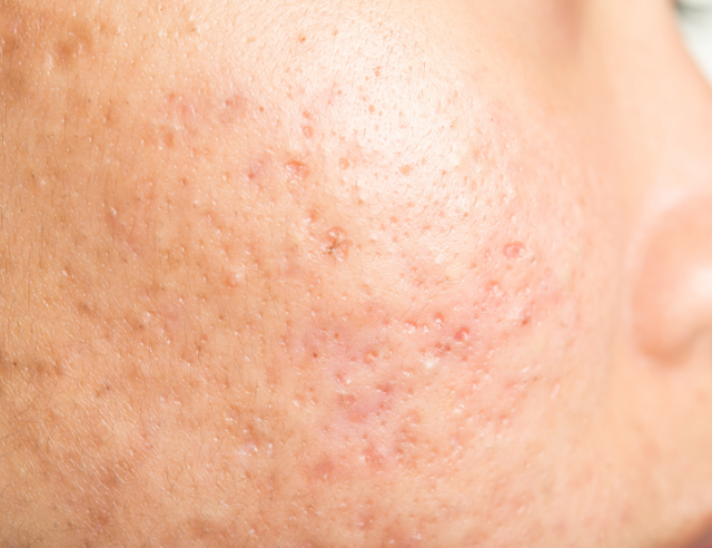 Sẹo kh&ocirc;ng chỉ ảnh hưởng thẩm mỹ m&agrave; c&ograve;n sức khỏe tinh thần- Ảnh 3.