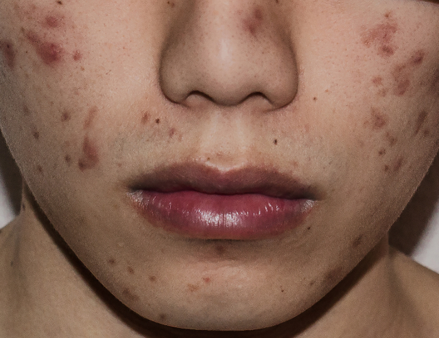 Sẹo kh&ocirc;ng chỉ ảnh hưởng thẩm mỹ m&agrave; c&ograve;n sức khỏe tinh thần- Ảnh 4.