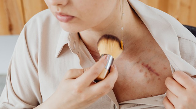 Cuộc chiến với sẹo: Nắm &lsquo;vũ kh&iacute;&rsquo; khoa học chống sẹo sau phẫu thuật- Ảnh 1.