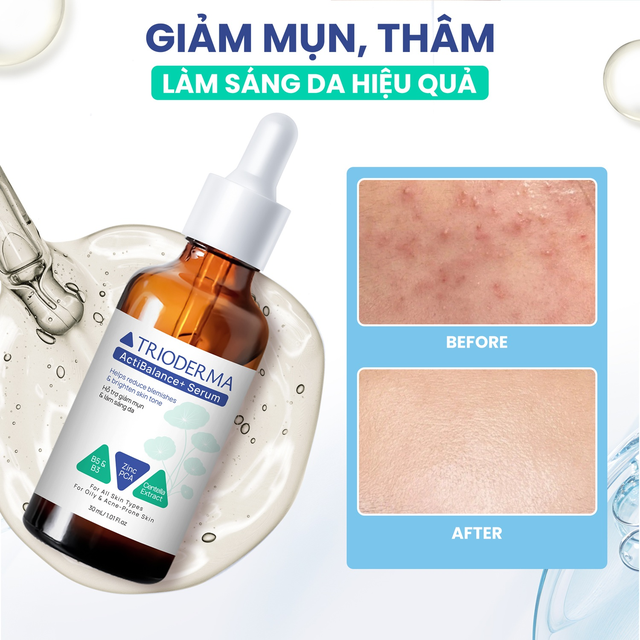 Trioderma gợi &yacute; chu tr&igrave;nh chăm s&oacute;c da mụn to&agrave;n diện, chuẩn y khoa tại nh&agrave; - Ảnh 5.