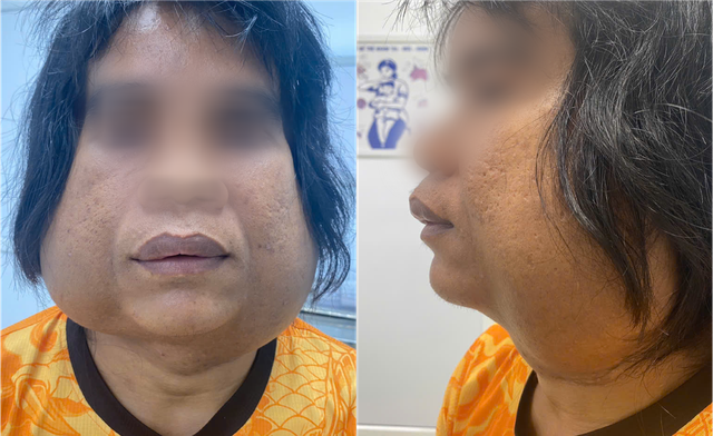 Choáng: Nam Thanh Niên Sống Cùng 2 Khối U Khổng Lồ Trên Mặt Suốt 10 Năm- Ảnh 1. Choáng: Nam Thanh Niên Sống Cùng 2 Khối U Khổng Lồ Trên Mặt Suốt 10 Năm- Ảnh 1.