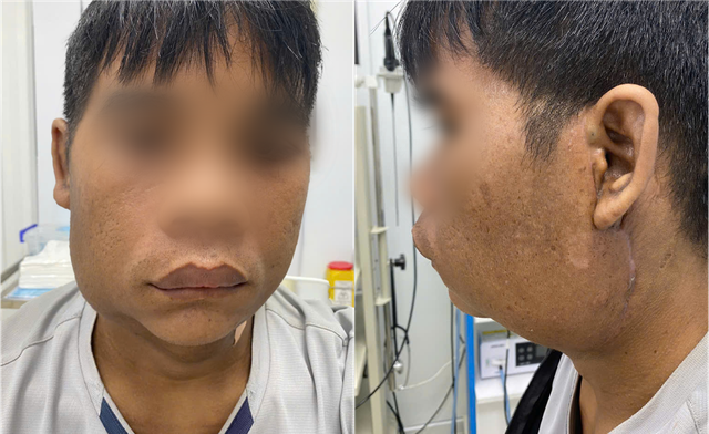 Choáng: Nam Thanh Niên Sống Cùng 2 Khối U Khổng Lồ Trên Mặt Suốt 10 Năm- Ảnh 4. Choáng: Nam Thanh Niên Sống Cùng 2 Khối U Khổng Lồ Trên Mặt Suốt 10 Năm- Ảnh 4.