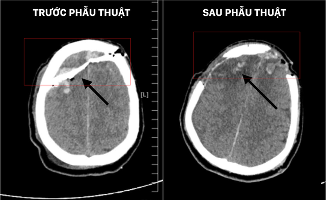 Vỡ Sọ, Dập Não Sau Xô Xát, Nam Thanh Niên Được Cứu Sống Đầy Ngoạn Mục - Ảnh 2.