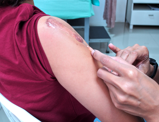 [Review nhanh] Top 5 c&aacute;ch trị sẹo lồi đang được thực hiện nhiều hiện nay- Ảnh 2.