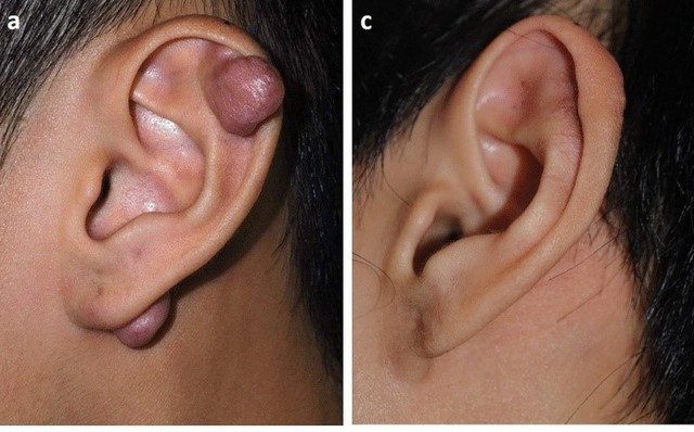 [Review nhanh] Top 5 c&aacute;ch trị sẹo lồi đang được thực hiện nhiều hiện nay- Ảnh 3.