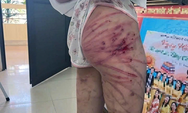 Bé gái 11 tuổi nhập viện, nghi bị cha dượng bạo hành- Ảnh 2. Bé gái 11 tuổi nhập viện, nghi bị cha dượng bạo hành- Ảnh 2.