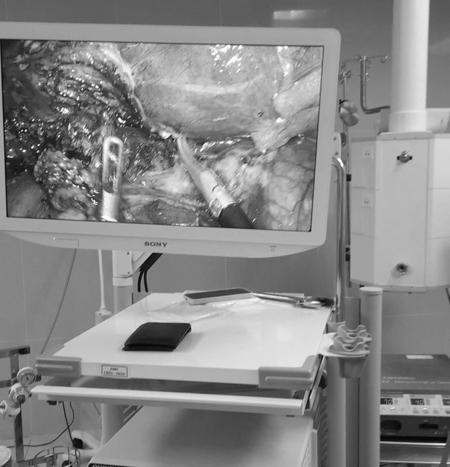 Cứu sống bệnh nhân rò túi mật – tá tràng kèm sỏi ống mật chủ hiếm gặp