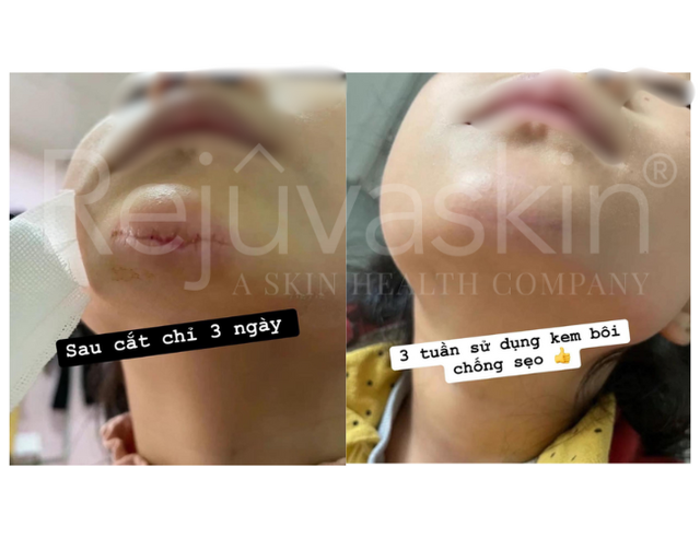 Silicone y tế: Ph&ograve;ng th&iacute; nghiệm đến ph&ograve;ng mổ - H&agrave;nh tr&igrave;nh c&ocirc;ng nghệ kiểm so&aacute;t sẹo   - Ảnh 3.