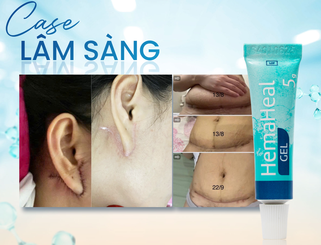 Hướng dẫn sử dụng gel HemaHeal - l&agrave;nh thương đ&uacute;ng chuẩn y khoa ngừa sẹo tối đa- Ảnh 5.