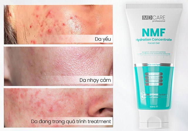 Top 6 kem dưỡng ẩm cho da dầu mụn mua 1 lại muốn 2 'ưng qu&aacute; chừng' - Ảnh 3.