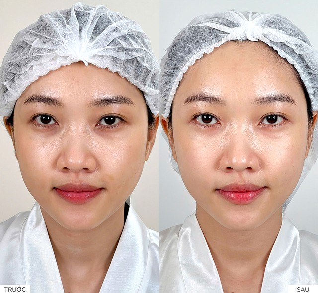 Revok50 - Giải pháp thẩm mỹ nội khoa cho làn da mỏng yếu và lão hóa sớm- Ảnh 2. Revok50 - Giải pháp thẩm mỹ nội khoa cho làn da mỏng yếu và lão hóa sớm- Ảnh 2.