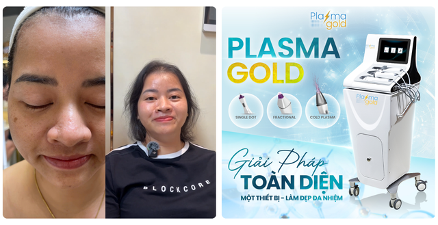 Review ch&acirc;n thực m&aacute;y Plasma Gold c&oacute; thật sự đ&aacute;ng để spa, thẩm mỹ viện đầu tư? - Ảnh 6.