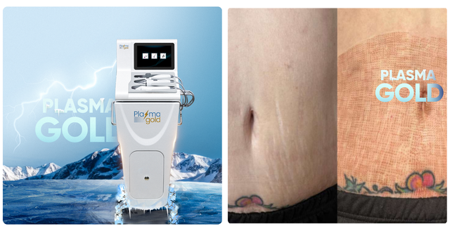 Review ch&acirc;n thực m&aacute;y Plasma Gold c&oacute; thật sự đ&aacute;ng để spa, thẩm mỹ viện đầu tư? - Ảnh 8.