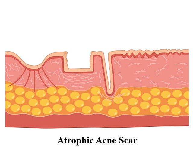 Sẹo mụn h&igrave;nh th&agrave;nh như thế n&agrave;o? Hiểu nguy&ecirc;n nh&acirc;n nắm r&otilde; c&aacute;ch x&oacute;a sẹo hiệu quả- Ảnh 1.