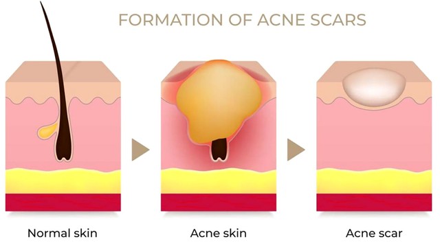 Sẹo mụn h&igrave;nh th&agrave;nh như thế n&agrave;o? Hiểu nguy&ecirc;n nh&acirc;n nắm r&otilde; c&aacute;ch x&oacute;a sẹo hiệu quả- Ảnh 2.