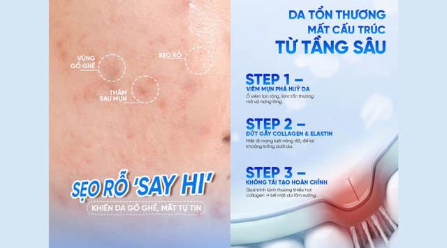 Đừng để sẹo mụn kéo…