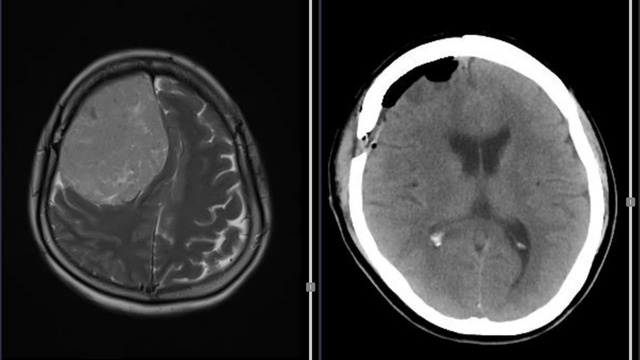 Đau đầu, yếu nửa người, khám bệnh phát hiện khối u màng não nặng 600 gram - Ảnh 1.