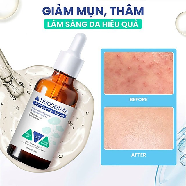 Hướng dẫn sử dụng serum giúp ngừa mụn Trioderma đúng chuẩn chuyên gia cho da khỏe đẹp - Ảnh 1.