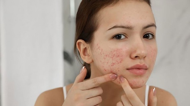 Hướng dẫn sử dụng serum giúp ngừa mụn Trioderma đúng chuẩn chuyên gia cho da khỏe đẹp - Ảnh 5.