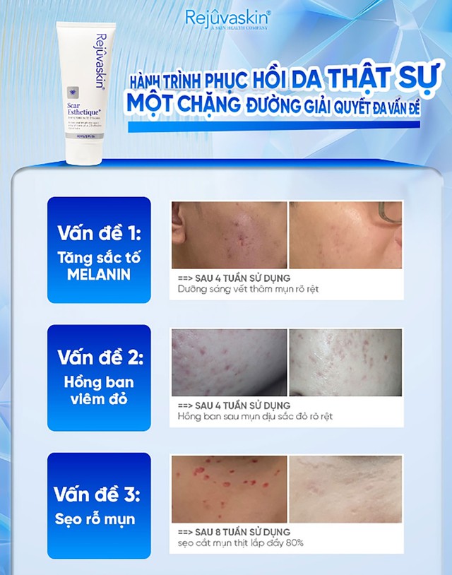 Sử dụng kem mờ sẹo chuẩn y khoa hiệu quả tăng gấp 3 ngừa t&aacute;i ph&aacute;t- Ảnh 8.