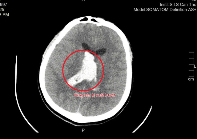 Thầy giáo trẻ đột quỵ nguy kịch sau những cơn đau đầu nhẹ - Ảnh 1.