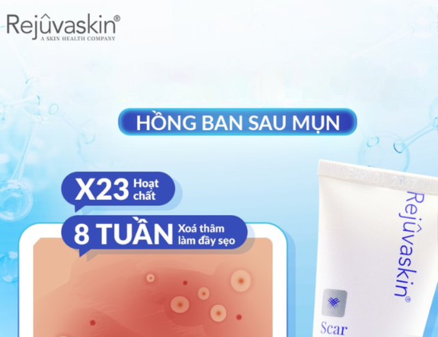 Da hết mụn m&agrave; vẫn loang lổ đỏ hồng? 90% chị em đang bỏ qua bước n&agrave;y! - Ảnh 1.