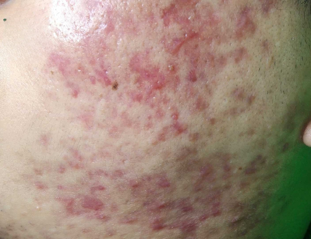 Da hết mụn m&agrave; vẫn loang lổ đỏ hồng? 90% chị em đang bỏ qua bước n&agrave;y! - Ảnh 2.