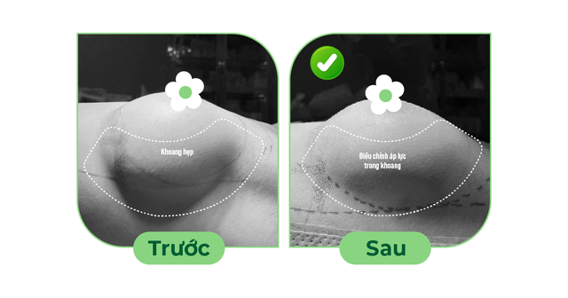 B&aacute;c sĩ Hồ Cao Vũ lựa chọn th&aacute;o t&uacute;i ngực m&ecirc; mask thanh quản - Ảnh 1.