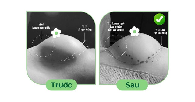 B&aacute;c sĩ Hồ Cao Vũ lựa chọn th&aacute;o t&uacute;i ngực m&ecirc; mask thanh quản - Ảnh 2.