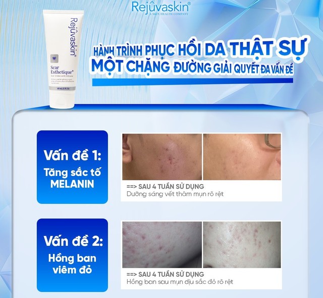 Skincare phục hồi da sau mụn tốt ngừa sẹo rỗ thâm đỏ sau 8 tuần- Ảnh 1.