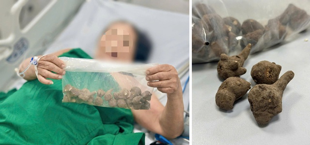 Nguy kịch do uống nước củ ấu tầu trị đau khớp - Ảnh 1.