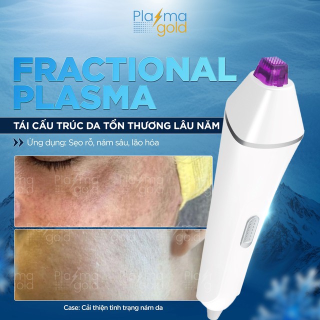 Plasma Lạnh trị sẹo rỗ v&agrave; se kh&iacute;t lỗ ch&acirc;n l&ocirc;ng như thế n&agrave;o?- Ảnh 9.