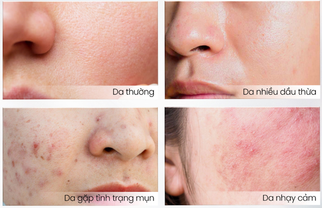 Top 9 sữa rửa mặt ngừa mụn sạch s&acirc;u m&agrave; kh&ocirc;ng kh&ocirc; da, ai d&ugrave;ng cũng m&ecirc;! - Ảnh 5.