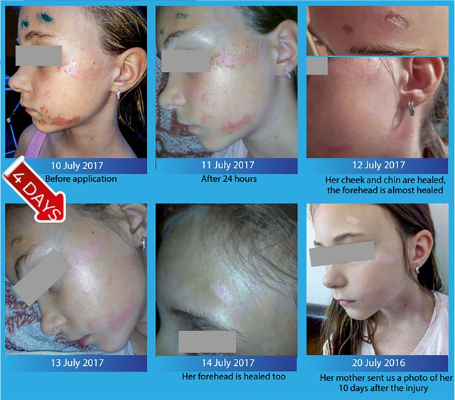 Khi nào nên chọn Hema để chăm sóc vết thương?- Ảnh 3.